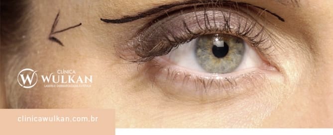 Correção da Pálpebra - Blefaroplastia