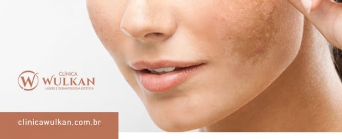 Melasma – manchas são comuns na gravidez