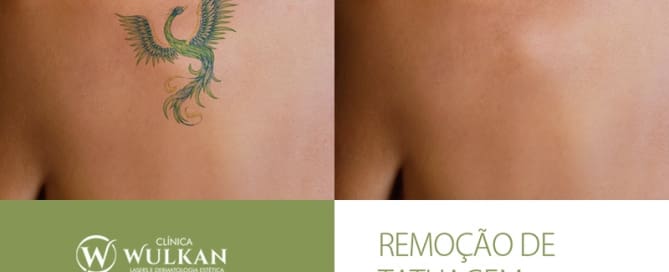 Tratamento de remoção de tatuagem