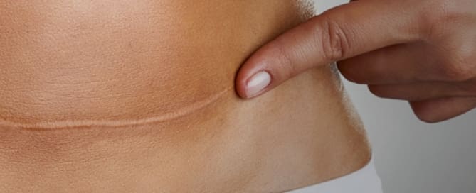 Adeus às cicatrizes!