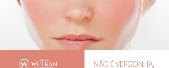 Não é vergonha, é rosácea
