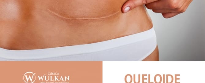 O que é Queloide?