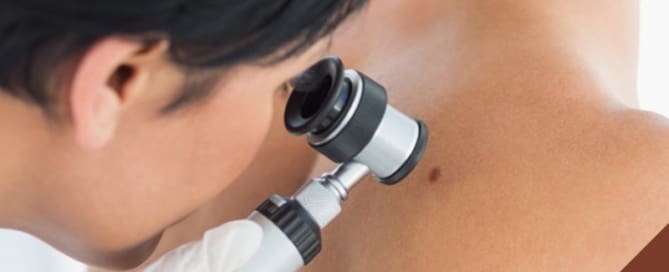 Câncer de pele não-melanoma