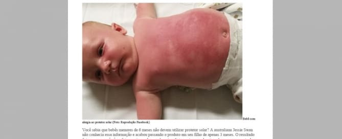Bebê de 3 meses é hospitalizado por causa do protetor solar