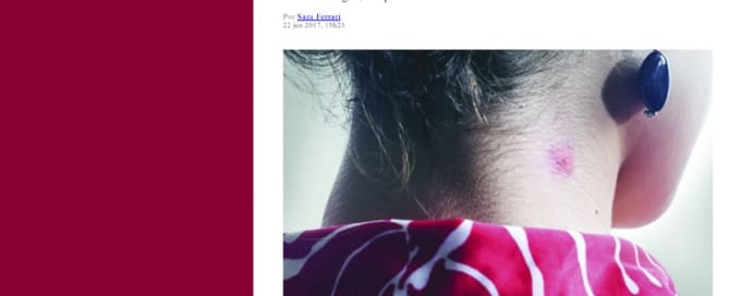 Como aliviar a coceira provocada pela picada de mosquito?