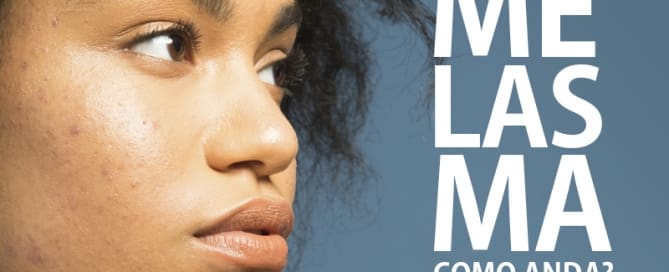 O tratamento do melasma, como anda?