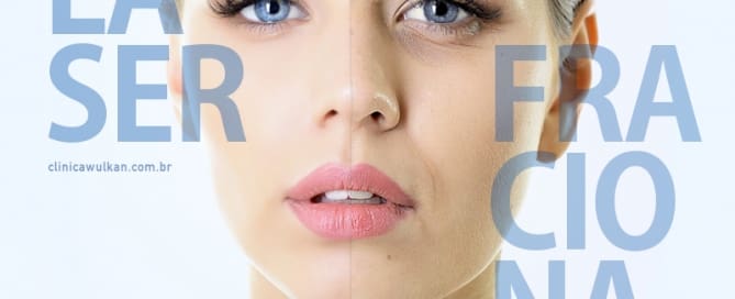 Laser Fracionado