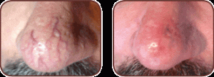 laser-para-vasinhos-nariz-sp-tratamento