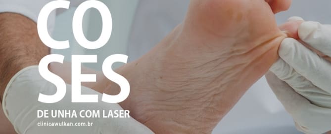 Tratamento de micoses de unha com laser