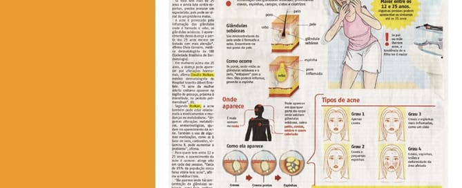 Espinhas que aparecem depois dos 25 anos merecem atenção