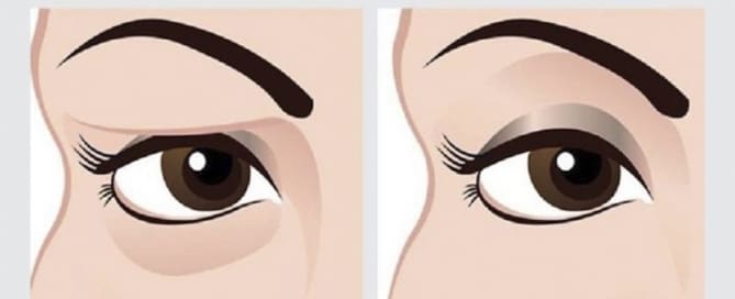 Opções de tratamento para Pálpebras