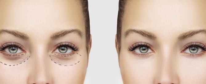 Blefaroplastia: cirurgia da pálpebra