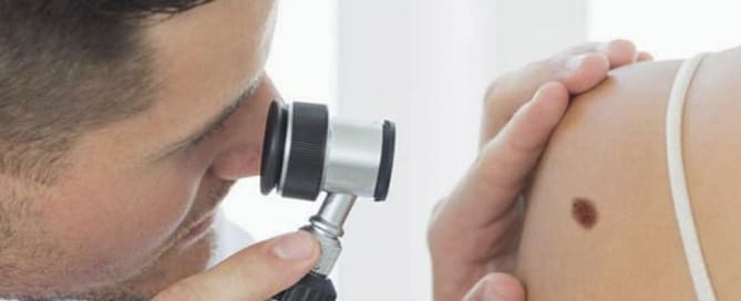 A detecção precoce do câncer de pele é fundamental para a cura da doença.