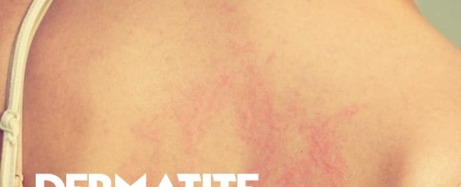 Dermatite atópica