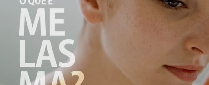 Você sabe o que é Melasma?