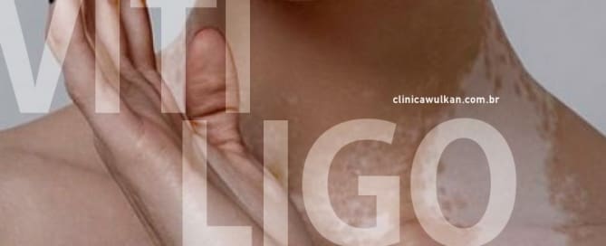 Vitiligo