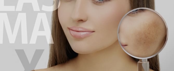 Melasma x vitamina D