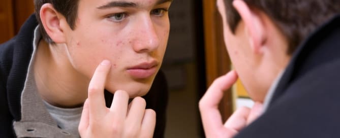 ACNE E ESPINHA: QUAL A DIFERENÇA?