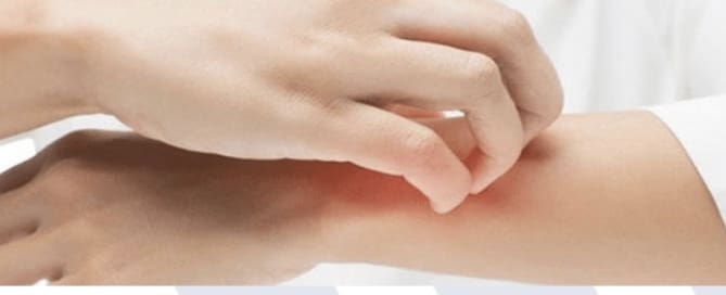 Dia Nacional de Prevenção de Alergia