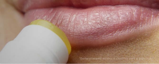 Lábios ressecados: Saiba como tratar a região.