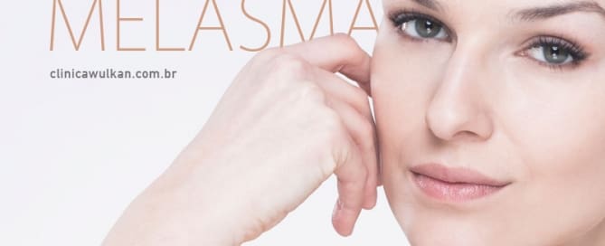 Melasma