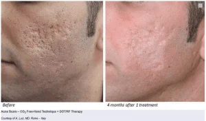 aplicacao de laser sp