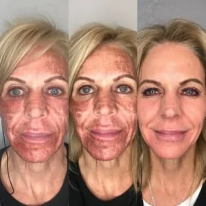 Laser de Co2 Fracionado aplicacao de laser CO2 sp