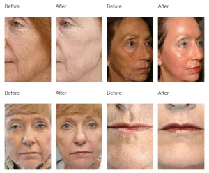 Laser de Co2 Fracionado aplicacao de laser CO2 sp