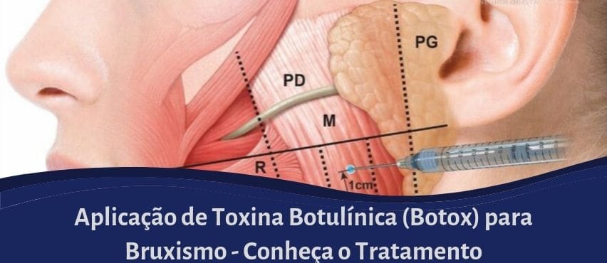 Toxina Botulínica/Botox para Bruxismo - Masseter - Dermatologista -  Especialista- Lasers, Preenchimento e Botox São Paulo