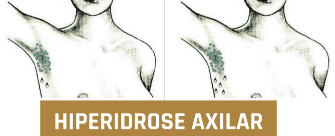 HIPERIDROSE AXILAR Hiperidrose Axilar