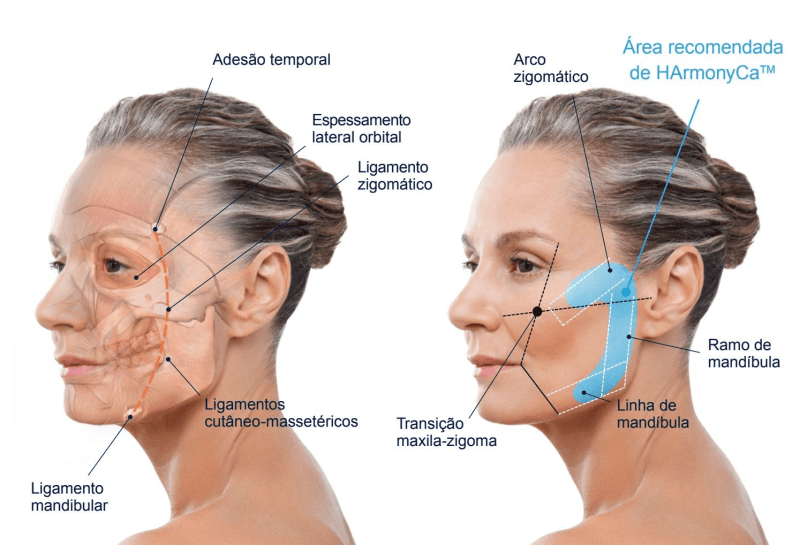 Aplicacao de HarmonyCA