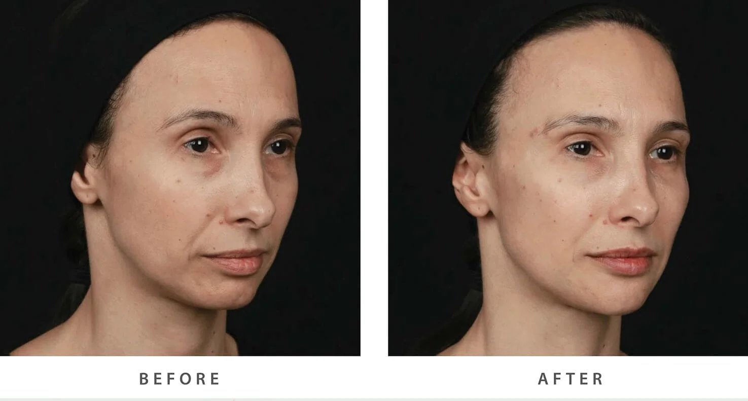 especialista soft lift especialista soft lift