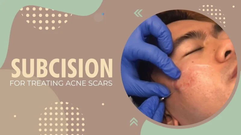 Clínica para tratamento de cicatriz de acne em São Paulo