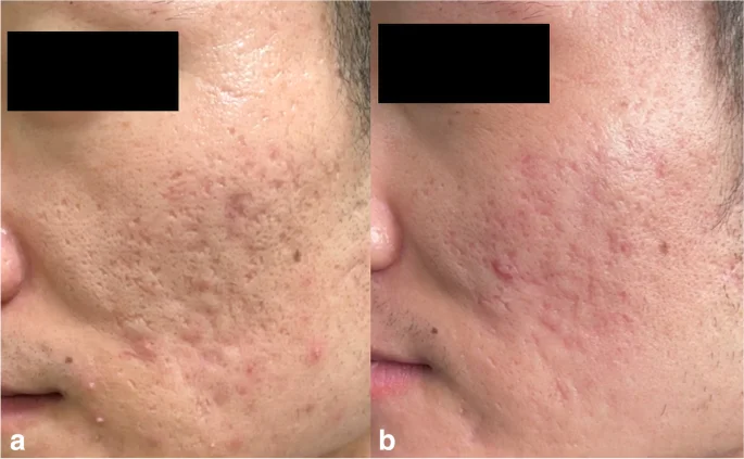 Laser CO2 fracionado para cicatriz de acne