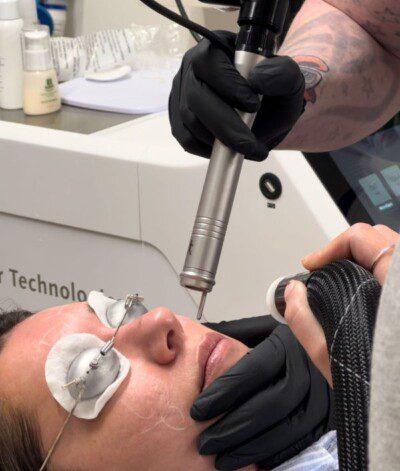 tratamento cicatriz de acne em sao paulo Tratamento de Cicatriz de Acne em São Paulo