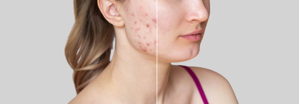 tratamento cicatriz de acne tratamento cicatriz de acne