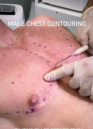 harmonizacao-peitoral-masculina