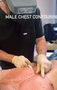 preenchimento peitoral acido hialuronico preenchimento peitoral acido hialuronico