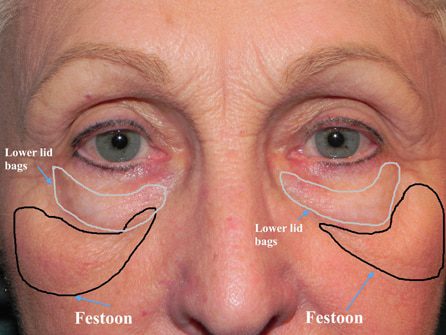 Tratamento Festoon Tratamento de Festoon