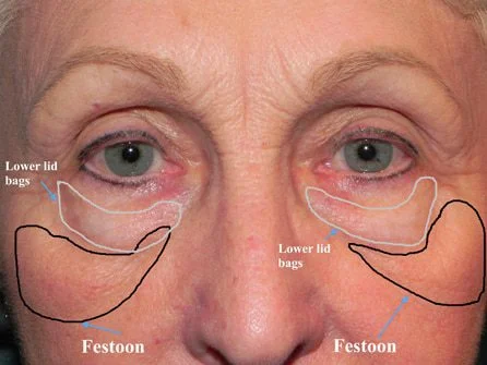 Tratamento Festoon Tratamento de Festoon