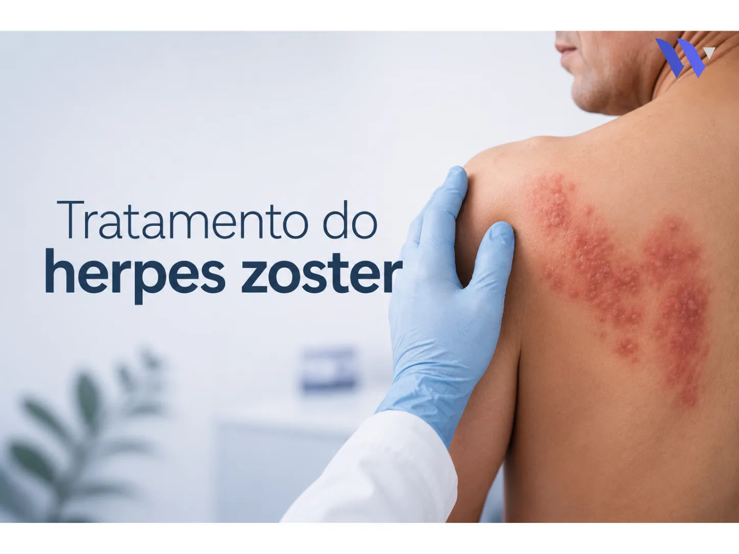 Herpes-Zóster: como se proteger do vírus