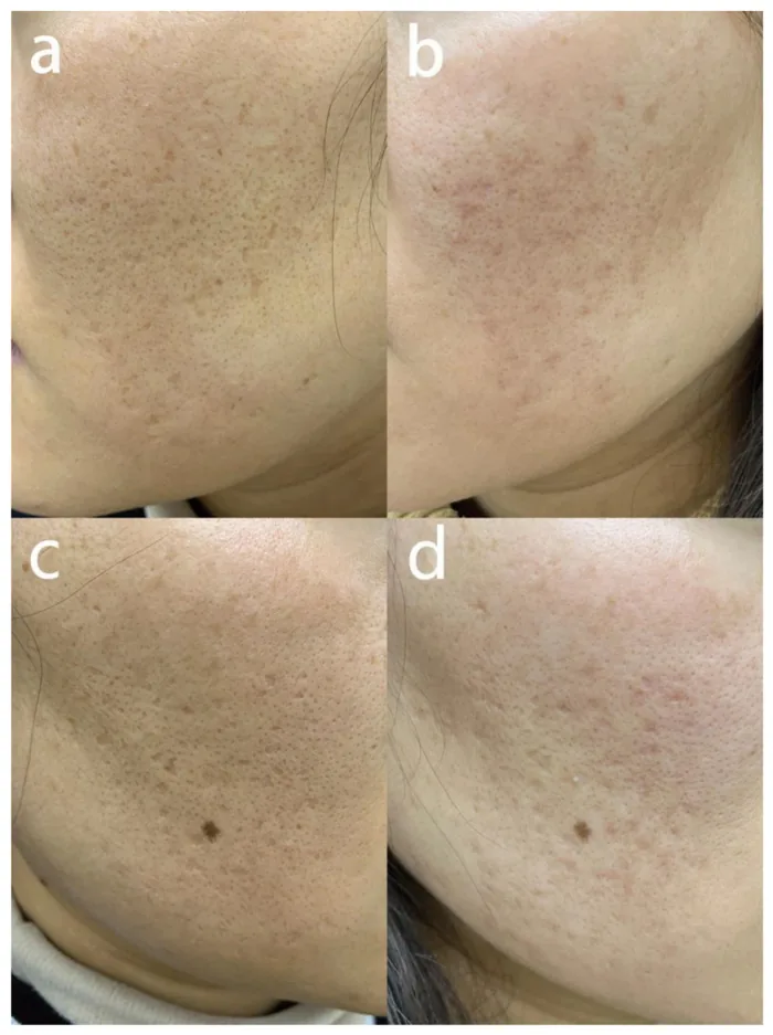 Laser de CO2 antes e depois em cicatrizes de acne boxcar e icepick, mulher de 31 anos, 3 meses após a primeira sessão