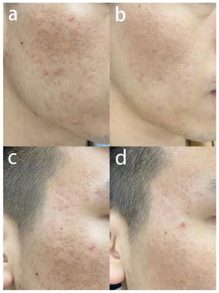 Laser de CO2 antes e depois em cicatriz de acne do tipo rolling na bochecha, homem de 25 anos, 3 meses após a segunda sessão