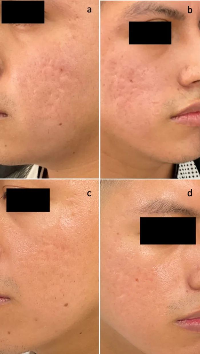 Laser de CO2 antes e depois em cicatriz de acne tratada com subcisão a laser combinada, 12 semanas após sessão única
