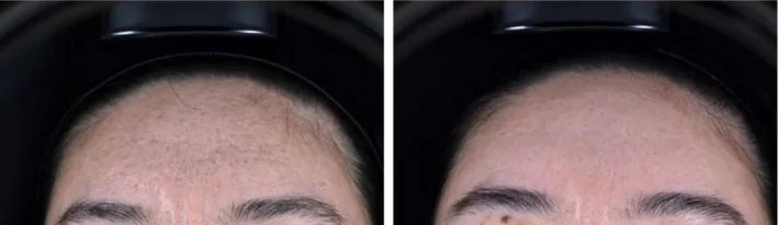 Laser de CO2 antes e depois em cicatriz de acne na testa, combinado com ácido poli-L-láctico