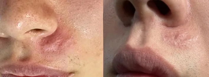 Laser de CO2 antes e depois em cicatriz hipertrófica antiga, com 6 anos de evolução, após três sessões