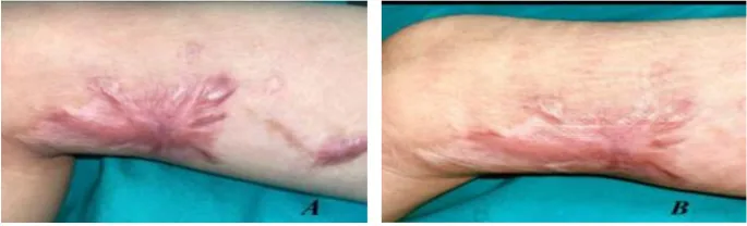 Laser de CO2 antes e depois em cicatriz hipertrófica de queimadura na dobra do cotovelo, 6 meses de tratamento