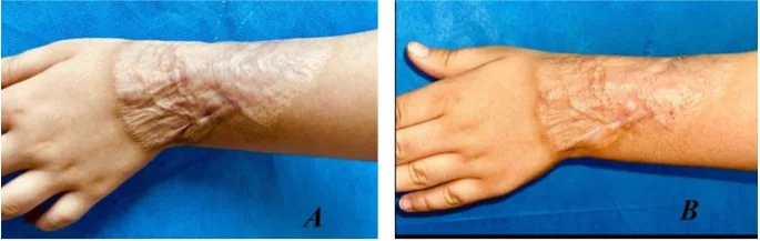 Laser de CO2 antes e depois em cicatriz hipertrófica de queimadura no punho e antebraço, 6 meses de tratamento