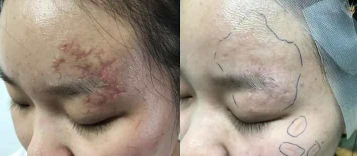 Laser de CO2 antes e depois em cicatriz atrófica na testa tratada precocemente, 1 mês após a lesão, em quatro sessões