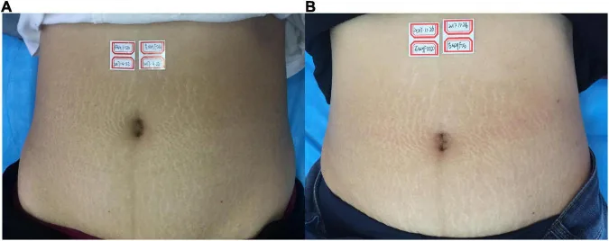 Laser de CO2 antes e depois em estrias brancas no abdome, 3 meses após a última de três sessões